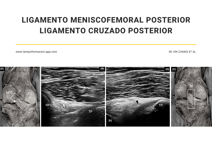 ligamento-meniscofemoral-posterior-y-ligamento-cruzado-posterior
